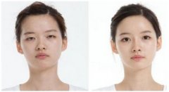 暑期整形提前預(yù)熱 高考生加入整容大軍
