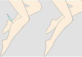 呼和浩特整形醫(yī)院腿部吸脂安全嗎