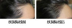 呼市整形發(fā)際線半永久可以維持多長時間?