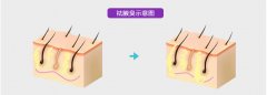 呼和浩特市激光祛腋臭效果如何?