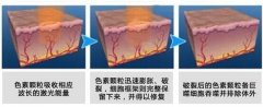 激光祛胎記效果怎么樣?