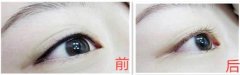 紋美瞳線的危害是什么?