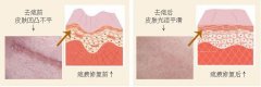 疤痕該怎樣去除呢?