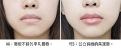 呼市三種注射豐唇的方法有哪些呢?