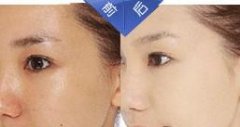 呼市美白針有沒有副作用?