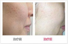 呼市美白針價(jià)格貴嗎?