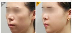 呼市自體脂肪豐面頰術(shù)后如何護(hù)理?