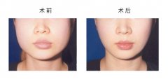呼市注射瘦臉瘦臉好不好?