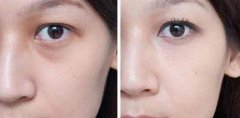 呼市激光去黑眼圈的效果好不好?