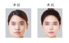 瘦臉的方式方法有哪些?