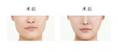 打瘦臉針價格貴嗎?