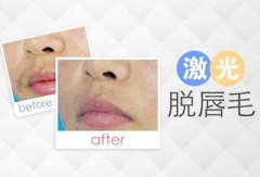 唇部脫毛貴不貴?注意事項是什么?