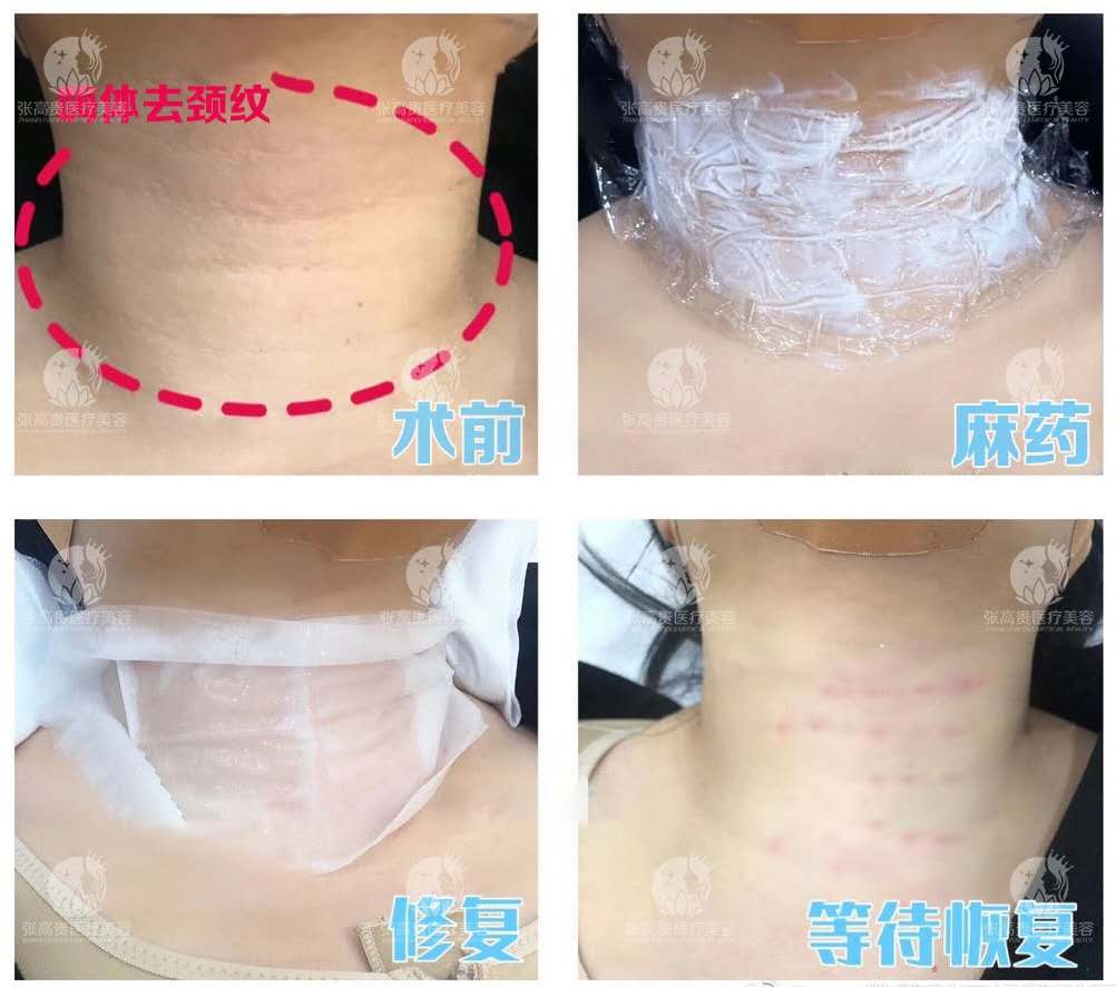 【嗨體去頸紋】從火雞脖到天鵝頸,你只需這樣做!