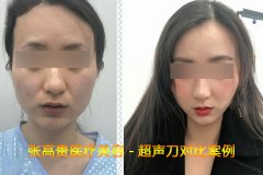 超聲刀做一次能維持多久?多久做一次才算好?呼市整形醫(yī)院