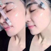 水光針的作用能維持多久